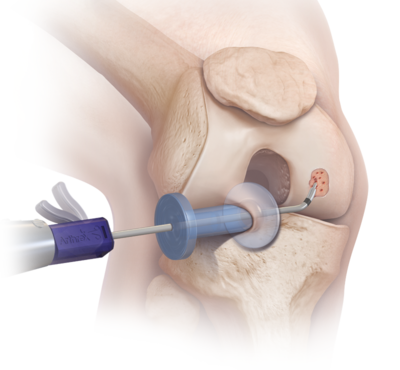Ghép sụn xương tự thân