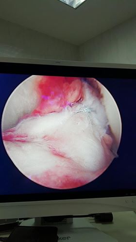 Bong chỗ bám dây chằng chéo trước ở đầu đùi